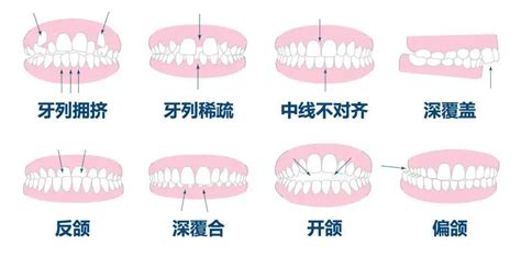 上排牙齒蓋住下排牙齒|牙齒咬合重要嗎？原來上下排牙齒咬合沒那麼簡單